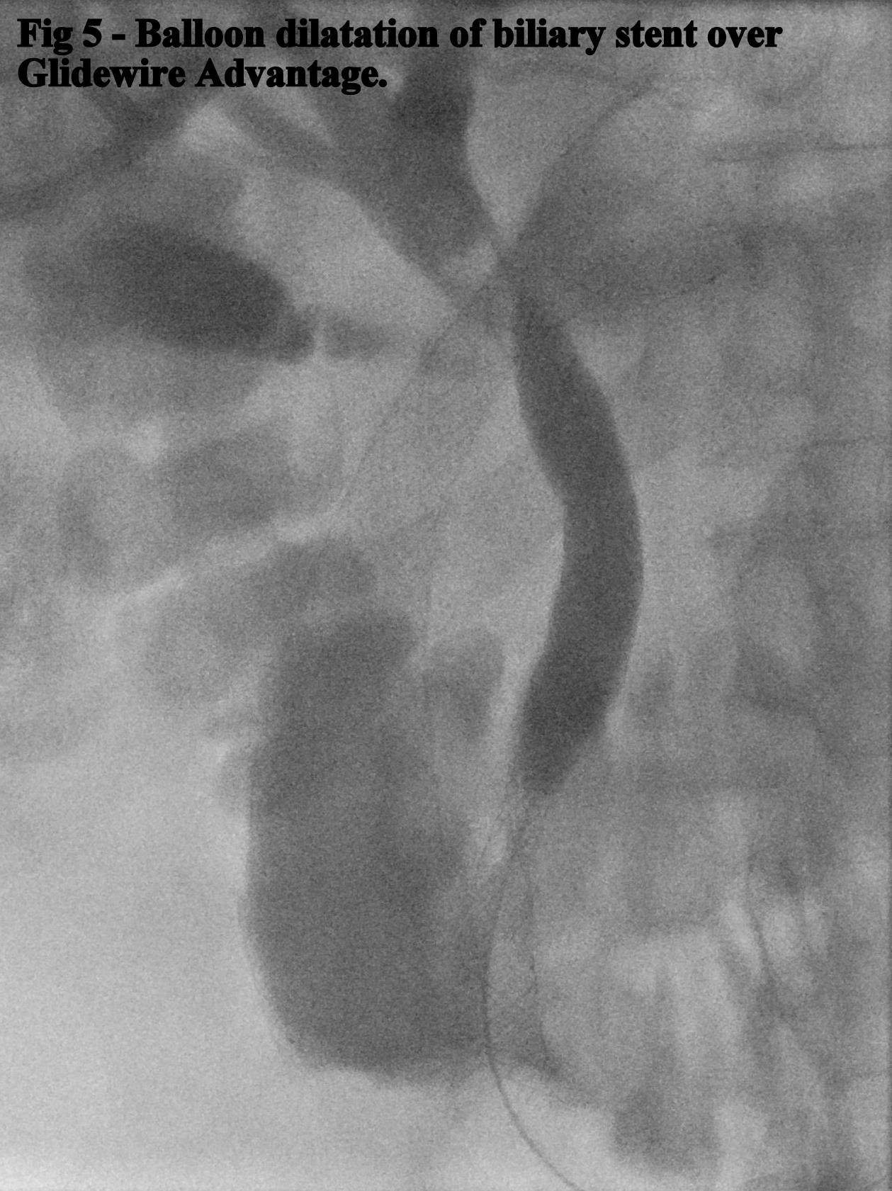 Fig 5. Ballon dilatation of biliary stent over Glidewire Advantage